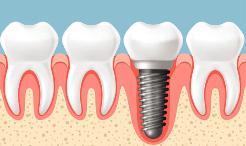 Factors That Affect Dental Implant Cost - Woodland Dental Center