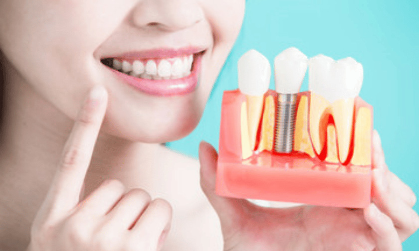 Know the benefits of dental implants.