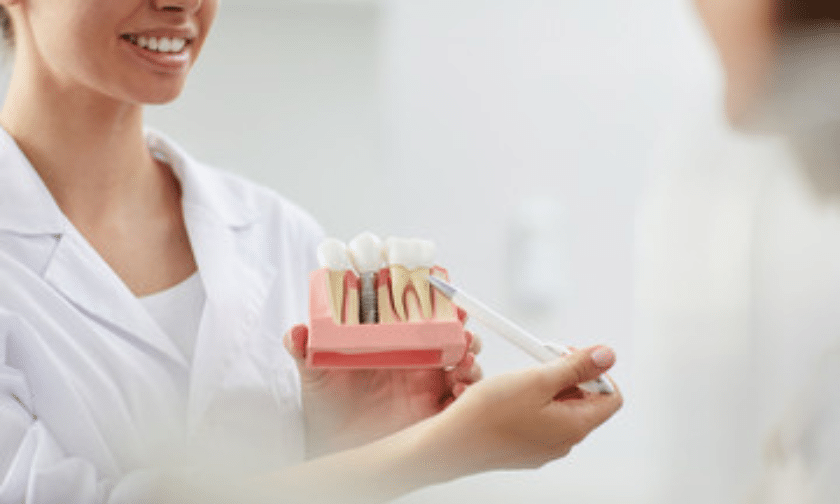 Points to consider before getting dental implants