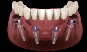 All on 4 dental implant procedure guide