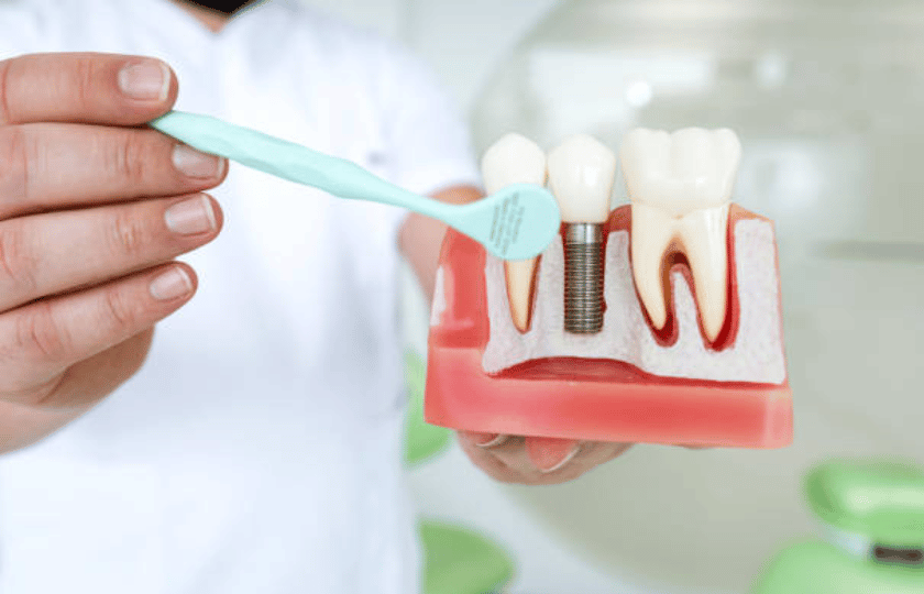 dental implants vs natural tooth