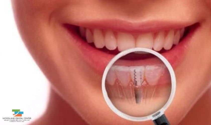 Close-up of tongue showing dental implant surface texture and integration with oral tissue.