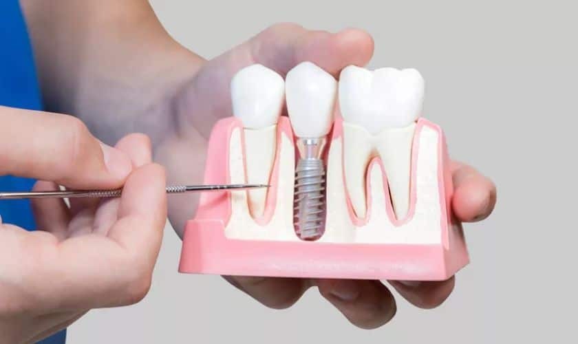 Dental implant model showing artificial tooth with metal screw between natural teeth on pink gum model.