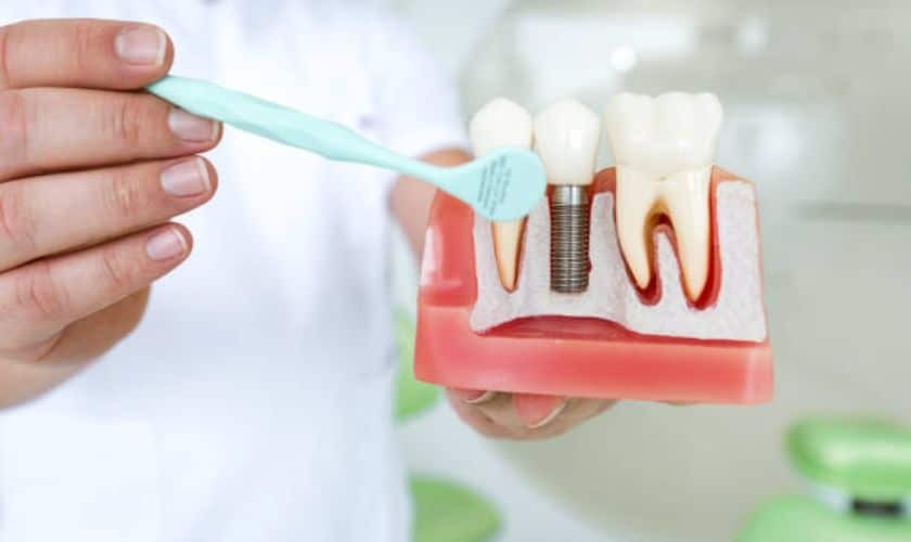 Dentist demonstrating dental implant components with model showing tooth, implant, and crown structure.