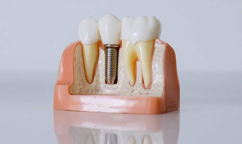 Dental implant model showing titanium screw fixture with crown between natural teeth on bone model.