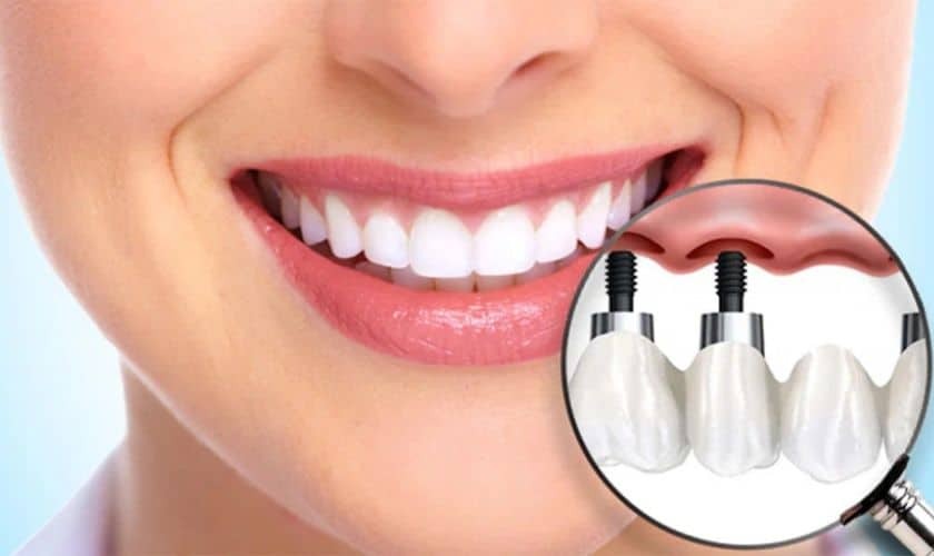 Woman smiling showing white teeth with dental implant diagram highlighting screw fixtures.