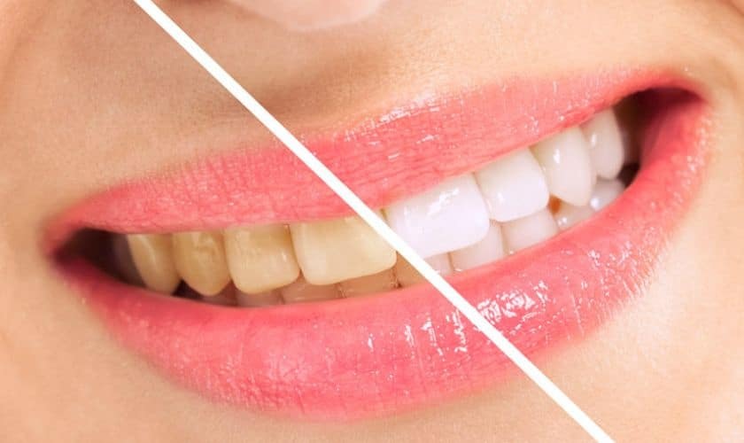 Before and after teeth whitening comparison showing discolored and brightened teeth.