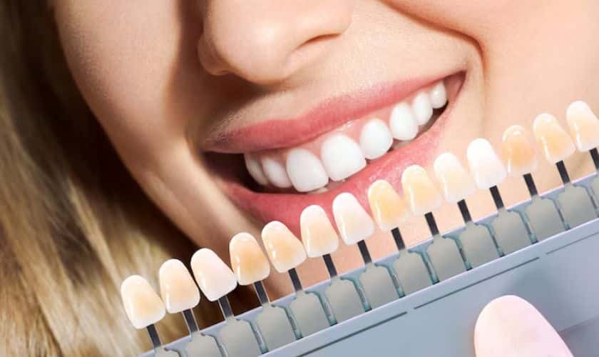 Woman smiling with teeth shade guide showing cosmetic whitening options for dental treatment.