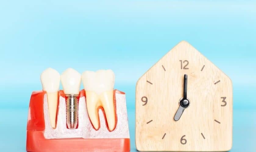 Dental implant model showing tooth replacement with screw component next to house-shaped clock.