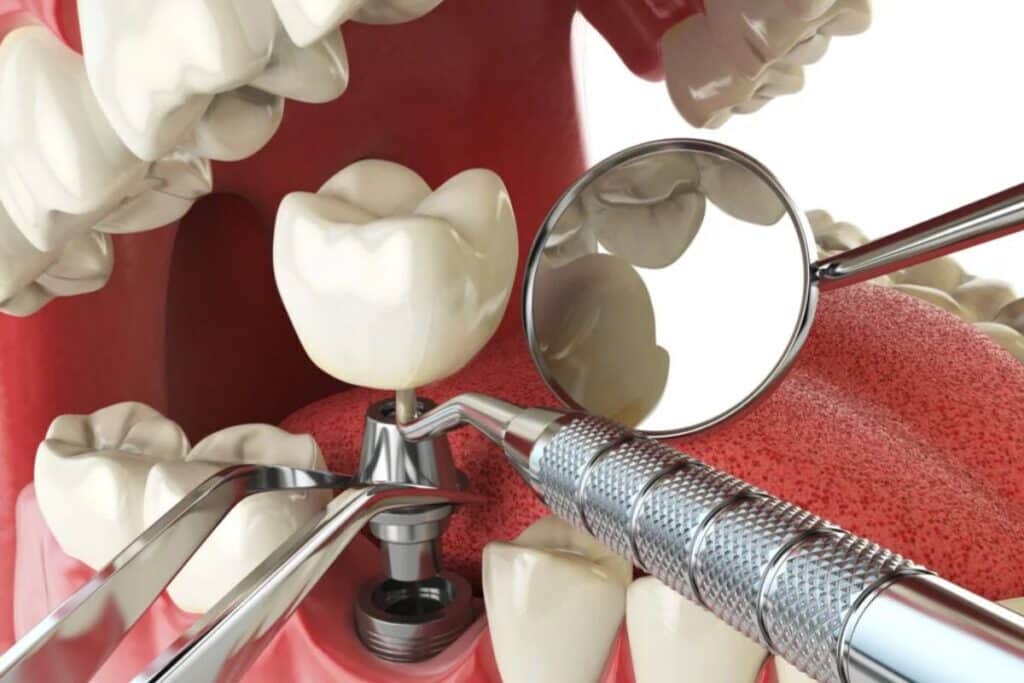 Dental implant illustration showing tooth replacement with mirror and surgical instruments on red background.