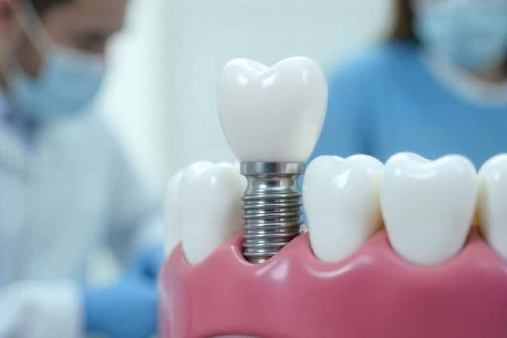 Dental implant model showing tooth crown on metal implant screw with adjacent natural teeth.
