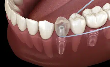 Dental implants near me