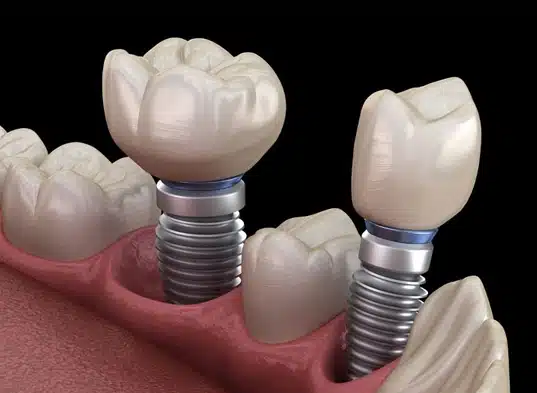 Dental implants