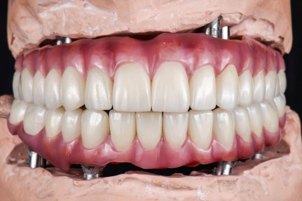 Full mouth dental implants with natural-looking ceramic teeth and pink gum prosthetics in Puyallup.
