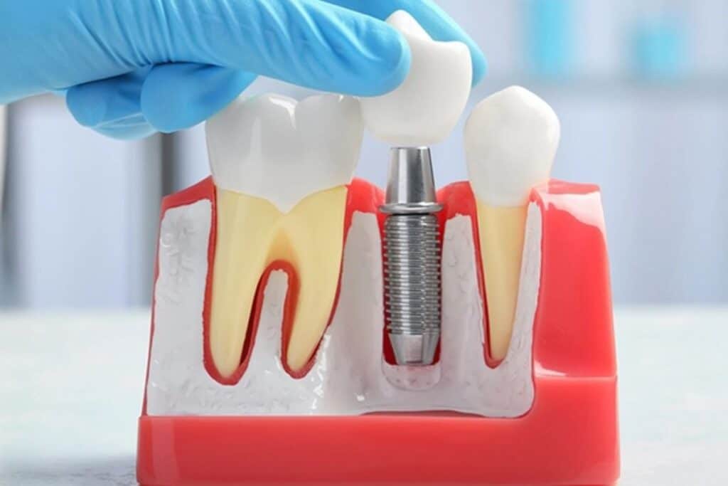 Dental implant model showing tooth replacement with crown and metal implant fixture in jawbone.
