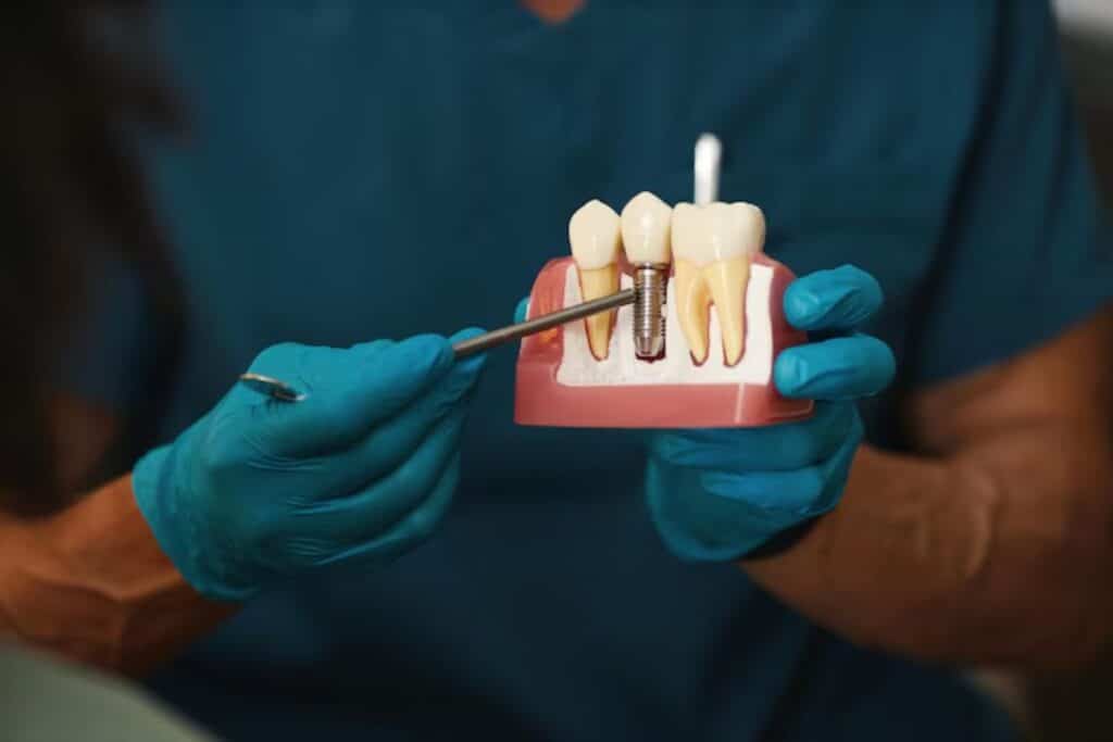 Dentist holding dental implant model showing tooth replacement with implant screw between natural teeth.