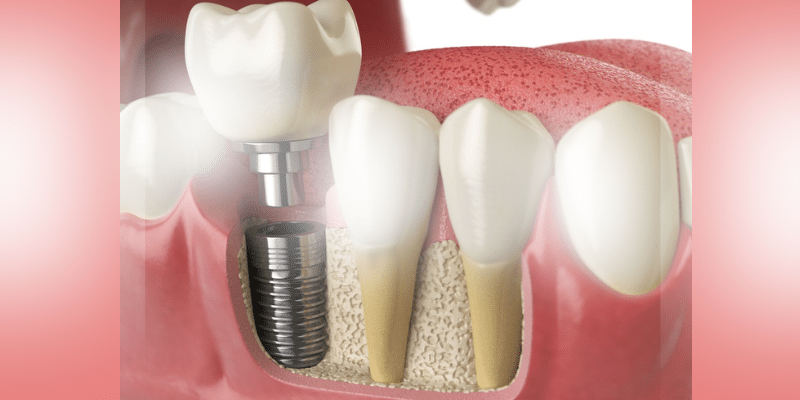 Dental implant diagram showing titanium screw, bone graft, and natural teeth in jawbone.