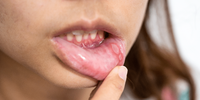 Child pointing to swollen gum and tooth showing signs of dental abscess infection.