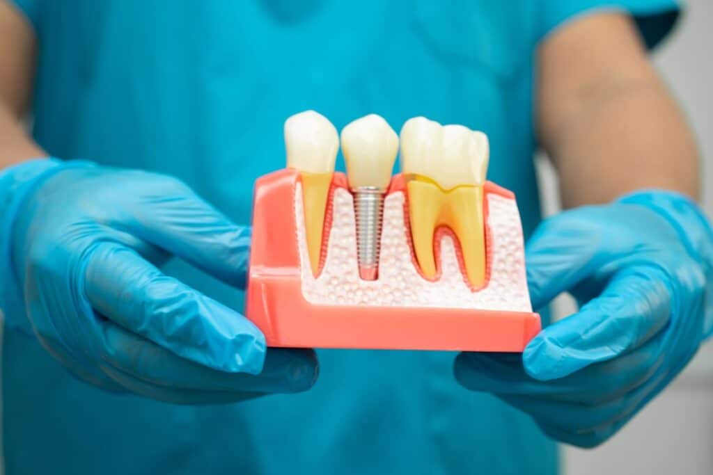 Dental implant model showing natural tooth, implant post, and crown structure with gum tissue.