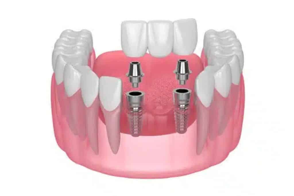Dental implant illustration showing two implants in jawbone with prosthetic teeth bridge in Puyallup.