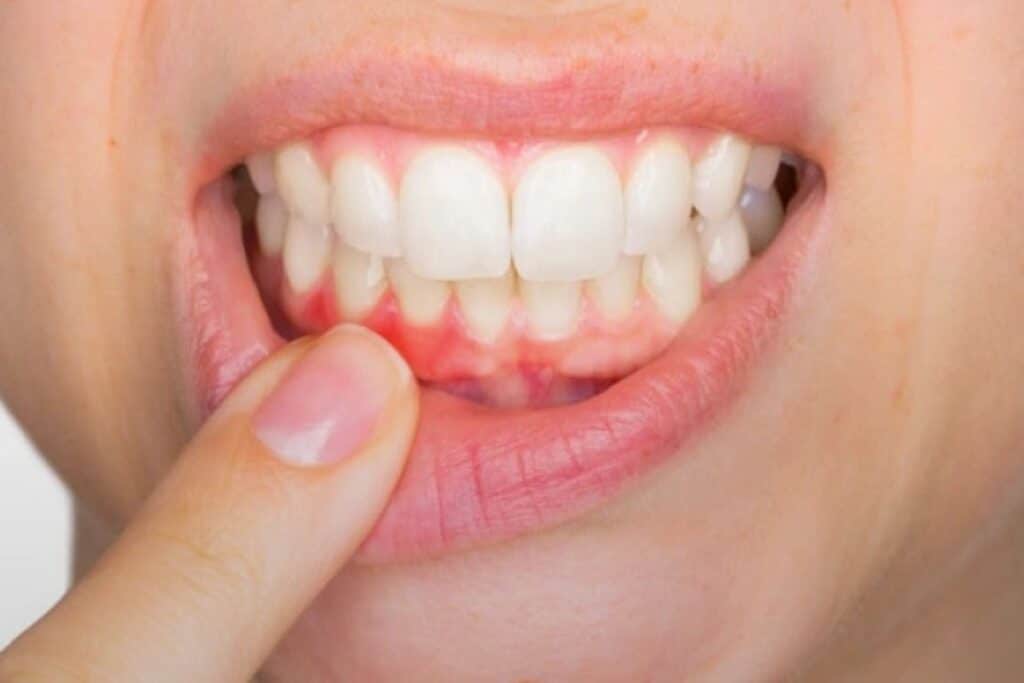 Woman pointing to inflamed gum tissue showing signs of gum disease and poor oral health.