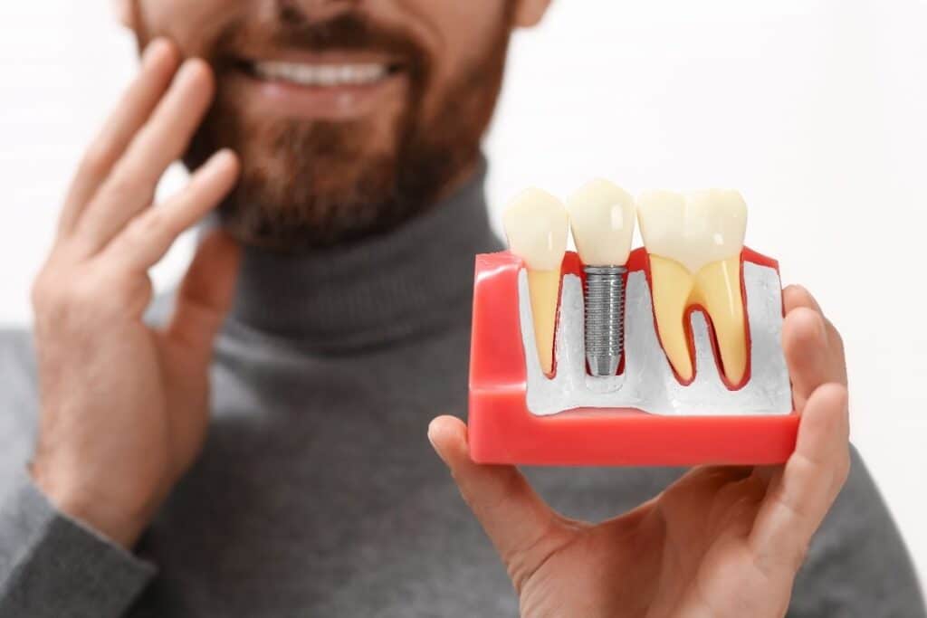 Man with beard holding dental implant model showing tooth replacement options.